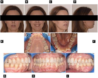 Digital orthodontic setup and clear aligners system for treating adult patients with periodontitis: a descriptive case report